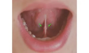 Cytotec sublingual